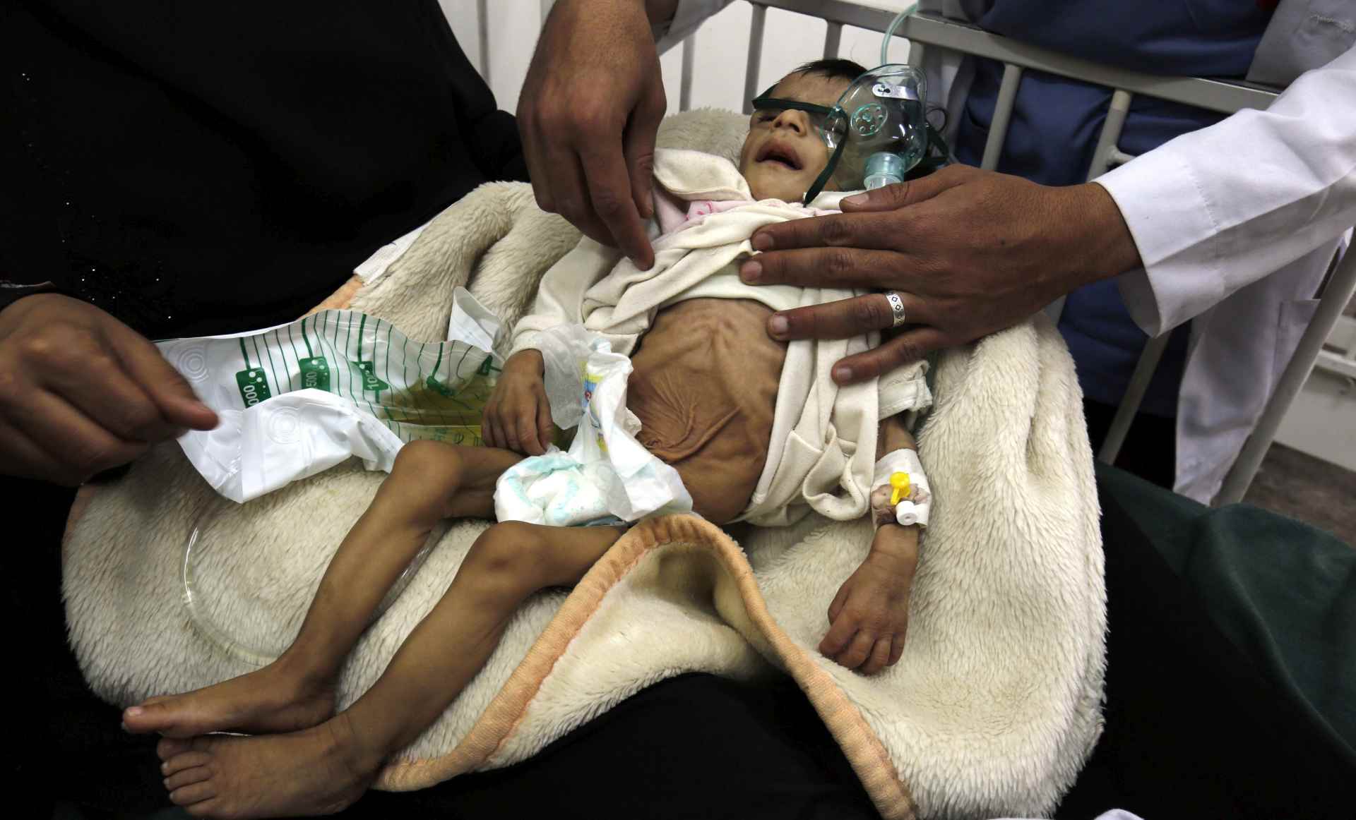 epa05732190 A picture made available on 19 January 2017 shows a Yemeni child, suffering from malnutrition, receiving treatment at a hospital in Sana'a, Yemen, 18 January 2017. According to reports, the UN children's fund UNICEF has reported that at least 462,000 Yemeni children are suffering from severe acute malnutrition, as food supplies have been disrupted by the nearly two-year escalating conflict between Yemen's Saudi-backed government forces and Houthi militias.  EPA/YAHYA ARHAB