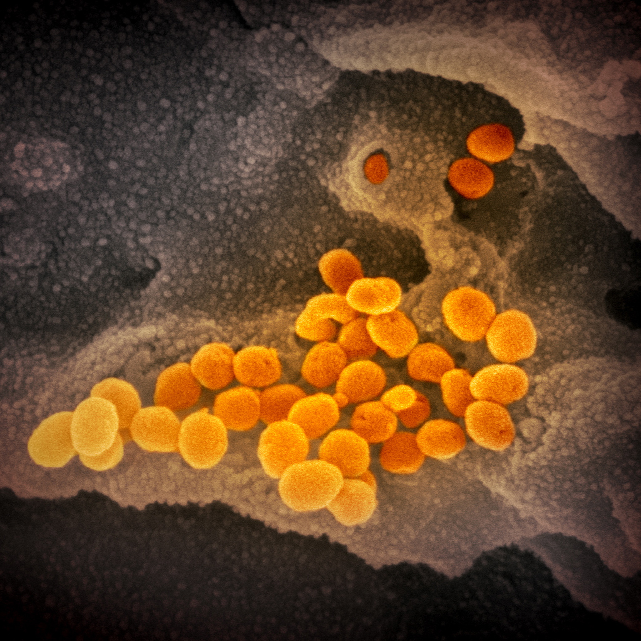epa08252651 An undated handout picture made available by the National Institutes of Health (NIH) shows a scanning electron microscope image of SARS-CoV-2 (orange) -- also known as 2019-nCoV, the virus that causes COVID-19 -- isolated from a patient in the USA, emerging from the surface of cells (gray) cultured in the lab (issued 27 February 2020). The novel coronavirus is on the verge of spreading across the world as more cases are emerging outside China with outbreaks in South Korea, Italy and Iran.  EPA/NIAID- RML/NATIONAL INSTITUTES OF HEALTH HANDOUT  HANDOUT EDITORIAL USE ONLY/NO SALES