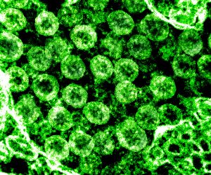 epa08262127 An undated handout picture made available by the National Institutes of Health (NIH) shows a transmission electron micrograph of SARS-CoV-2 virus particles, also known as 2019-nCoV, the virus that causes Covid-19, isolated from a patient (issued 01 March 2020). The image was captured and color-enhanced at the National Institute of Allergy and Infectious Diseases (NIAID) Integrated Research Facility (IRF) in Fort Detrick, Maryland, USA. US health officials announced on 29 February 2020 the first confirmed death from the new coronavirus in the country in Washington State. The novel coronavirus is on the verge of spreading across the world as more Covid-19 cases are emerging outside China with outbreaks in South Korea, Italy and Iran.  EPA/NIAID/NATIONAL INSTITUTES OF HEALTH HANDOUT  HANDOUT EDITORIAL USE ONLY/NO SALES