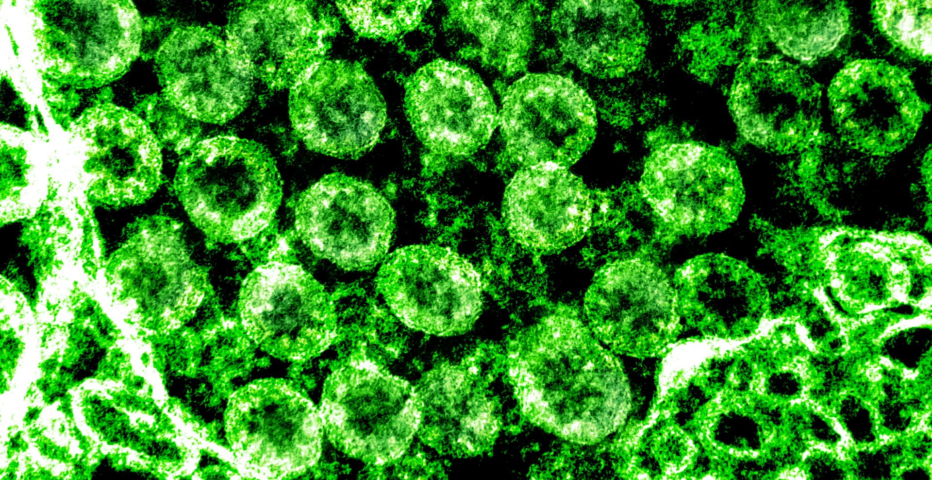 epa08262127 An undated handout picture made available by the National Institutes of Health (NIH) shows a transmission electron micrograph of SARS-CoV-2 virus particles, also known as 2019-nCoV, the virus that causes Covid-19, isolated from a patient (issued 01 March 2020). The image was captured and color-enhanced at the National Institute of Allergy and Infectious Diseases (NIAID) Integrated Research Facility (IRF) in Fort Detrick, Maryland, USA. US health officials announced on 29 February 2020 the first confirmed death from the new coronavirus in the country in Washington State. The novel coronavirus is on the verge of spreading across the world as more Covid-19 cases are emerging outside China with outbreaks in South Korea, Italy and Iran.  EPA/NIAID/NATIONAL INSTITUTES OF HEALTH HANDOUT  HANDOUT EDITORIAL USE ONLY/NO SALES