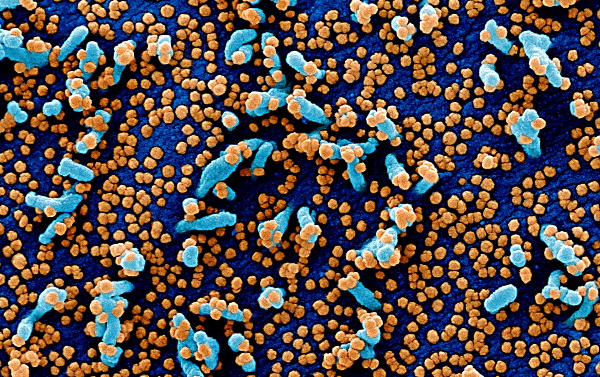 epa08319728 An undated handout image captured and color-enhanced at the National Institute of Allergy and Infectious Diseases (NIAID) Integrated Research Facility (IRF) in Fort Detrick, Maryland, USA and made available by the National Institutes of Health (NIH) shows a colorized scanning electron micrograph of a VERO E6 cell (blue) heavily infected with SARS-COV-2 virus particles (orange), isolated from a patient sample (issued 24 March 2020). The novel coronavirus SARS-COV-2, which causes the Covid-19 disease, has been recognized as a pandemic by the World Health Organization (WHO) on 11 March 2020.  EPA/NIAID/NATIONAL INSTITUTES OF HEALTH HANDOUT  HANDOUT EDITORIAL USE ONLY/NO SALES