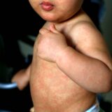 child with measles symptoms salvador, bahia / brazil - february 14, 2017: Child with measles symptoms is seen with small red spots on body and feverish state. *** Local Caption *** . SALVADOR BAHIA BRASIL Copyright: xJoaxSouzax 220117JOA05Z,Image: 803183975, License: Rights-managed, Restrictions: imago is entitled to issue a simple usage license at the time of provision. Personality and trademark rights as well as copyright laws regarding art-works shown must be observed. Commercial use at your own risk., Credit images as "Profimedia/ IMAGO", Model Release: no, Credit line: Joa Souza / imago stock&people / Profimedia