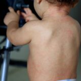 child with measles symptoms salvador, bahia / brazil - february 14, 2017: Child with measles symptoms is seen with small red spots on body and feverish state. *** Local Caption *** . SALVADOR BAHIA BRASIL Copyright: xJoaxSouzax 220117JOA04Z,Image: 803183970, License: Rights-managed, Restrictions: imago is entitled to issue a simple usage license at the time of provision. Personality and trademark rights as well as copyright laws regarding art-works shown must be observed. Commercial use at your own risk., Credit images as 